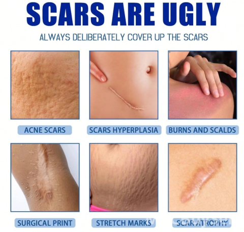 Scar Smoothing Cream | Scar Removal & Repair 3