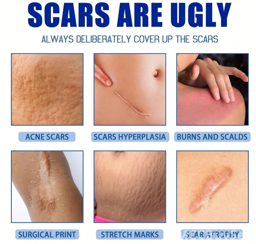Scar Smoothing Cream | Scar Removal & Repair